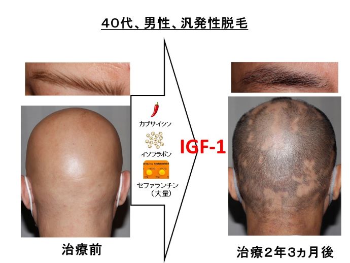 円形脱毛症　病院